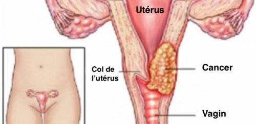6 Symptômes du cancer du col de l’utérus Vous devez savoir